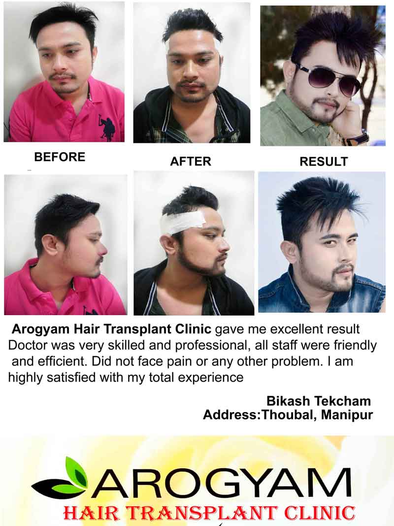 Best Hair Transplant in Guwahati  Assamese Singer Simantha Sekhar DHI  Hair Transplant in Guwahati  YouTube